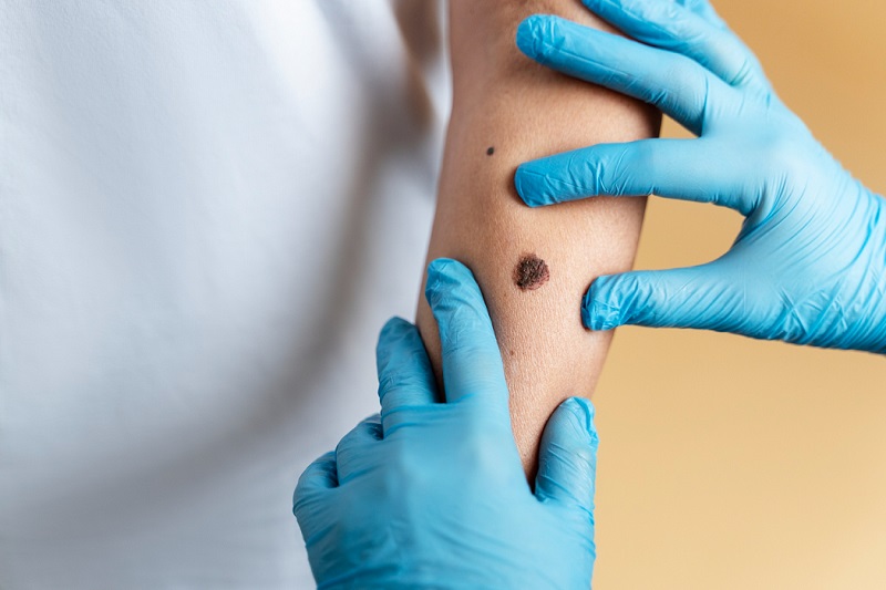 What is melanoma and why is it dangerous? Dermatologist explains