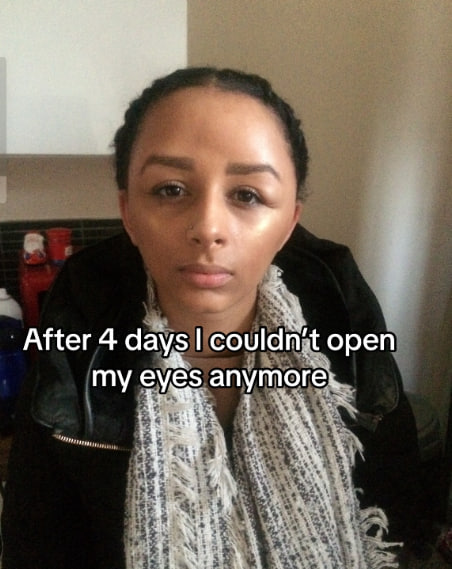 Woman dyes hair and nearly dies: See what happened to her head