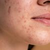5 everyday foods that can cause acne