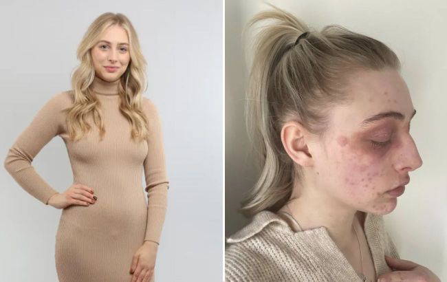 Popular eyelash product sent girl to hospital looking like 'plague victim' (photo)