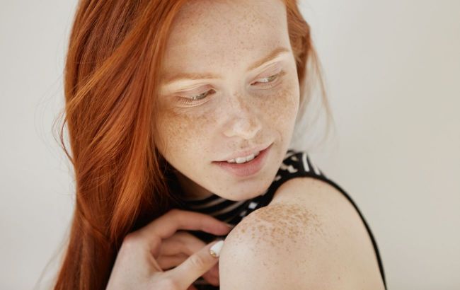 Not just sun: Unexpected reasons behind pigment spots revealed
