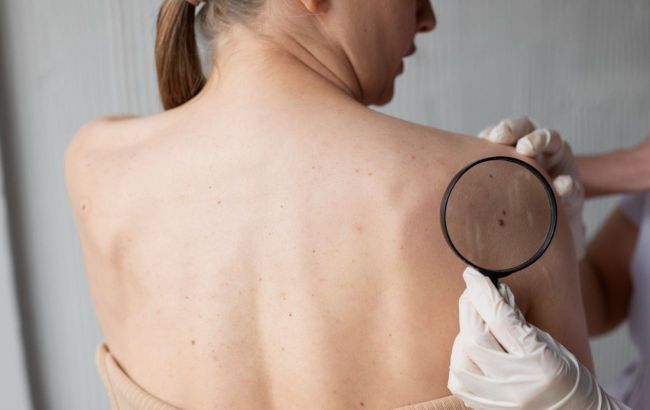 Dermatologist explains why hair can grow from mole