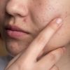 Biggest mistake if you have acne or breakouts