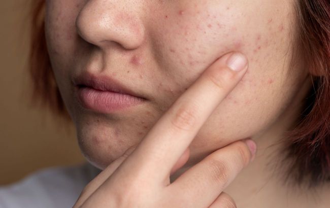 Biggest mistake if you have acne or breakouts