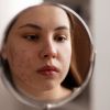 Dermatologist reveals 5 common myths about acne