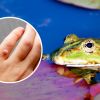 Dermatologist explains whether warts really appear from contact with frogs