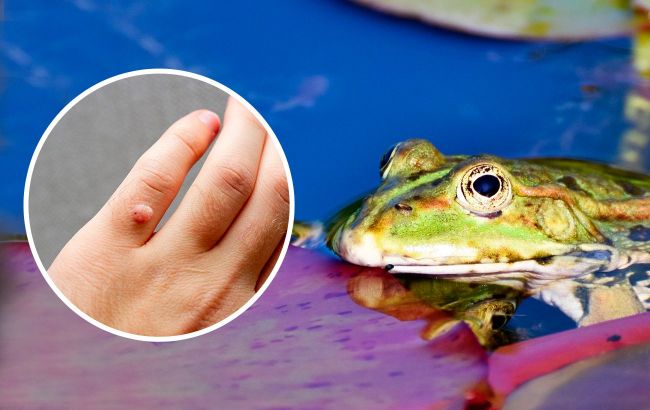 Dermatologist explains whether warts really appear from contact with frogs