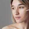 Dermatologist debunks 12 common acne myths everyone still believes