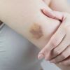 How to speed up bruise healing: Doctor's advice