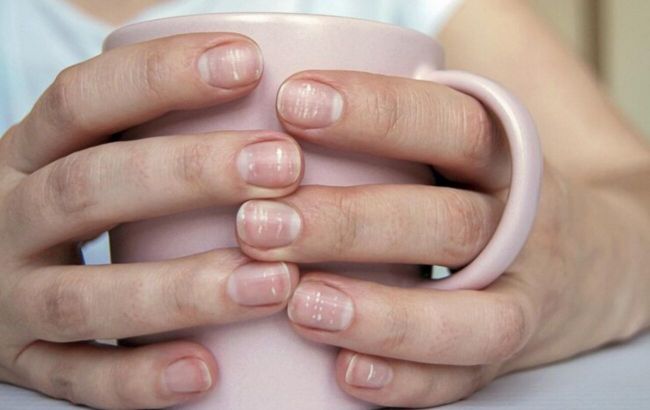 Dermatologist reveals nail spots that may indicate cancer - Video
