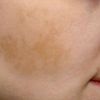 Forget expensive treatments and salon procedures: One cream may help with pigmentation