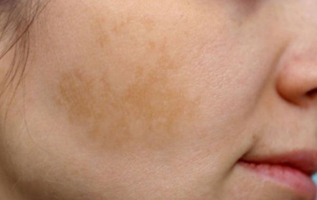 Forget expensive treatments and salon procedures: One cream may help with pigmentation
