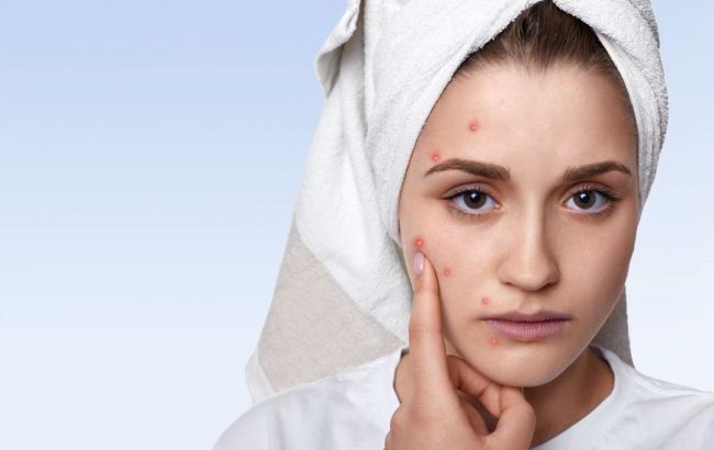 Is acne face map myth or reality? Insights from dermatologist